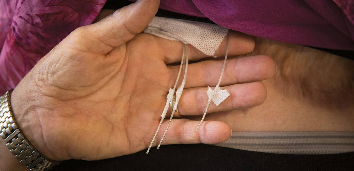 Spinal Stimulators Repurposed to Restore Touch in Lost Limbs