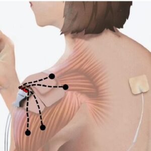 New Evidence: Peripheral Nerve Stimulation Zaps Amputee Pain