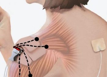 New Evidence: Peripheral Nerve Stimulation Zaps Amputee Pain