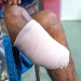 Saving Limbs, Improving Lives During National Diabetes Month