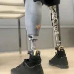 Medicare Coverage for 3D-Printed Prostheses Is Finally Here