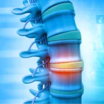 Spinal Cord Stimulation Zaps Phantom Limb Pain