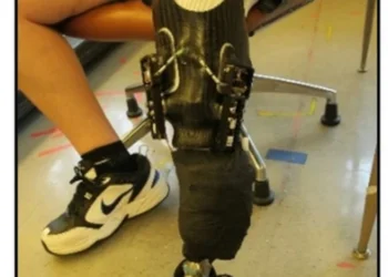 Prototype Smart Socket Shows Promise for Amputees’ Comfort