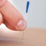 Relieving Pain With Needles?