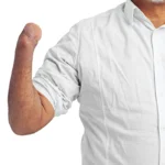 Why Do So Many Amputees Abandon Their Prosthesis?